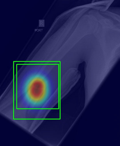 AI-Powered Bone Fracture Detection Illustration
