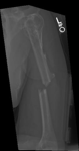 Ankle X-ray