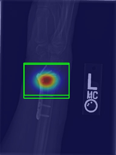 Wrist X-ray with Grad-CAM visualization