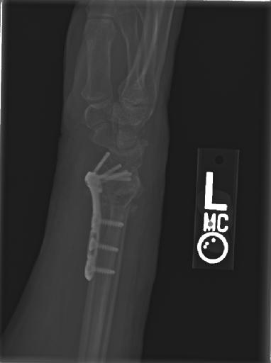 Wrist X-ray
